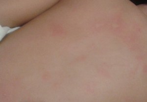 urticaria